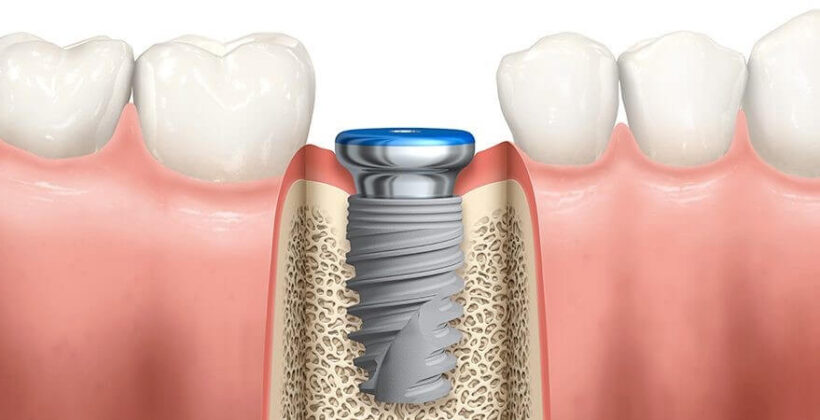 6 lucruri despre implanturi dentare pe care dentistul nu ti le spune. Numarul 3 te va uimi!