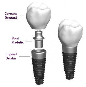 implanturile dentare 
