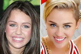 Miley Cyrus dental implant