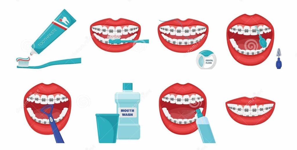 Spalatul dintilor pe timpul tratamentului cu aparat dentar