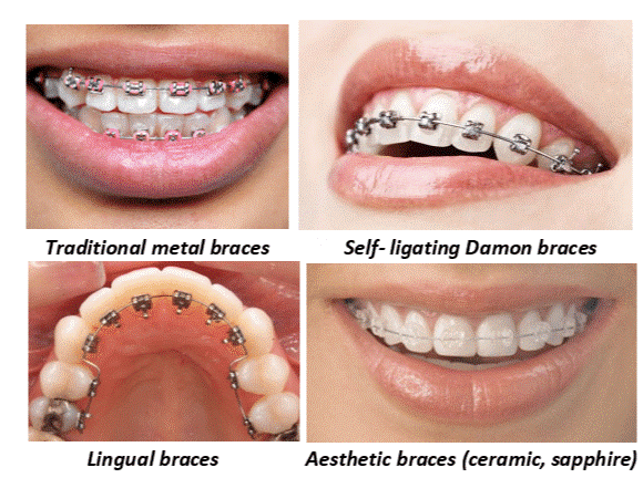 Aparatele dentare fixe