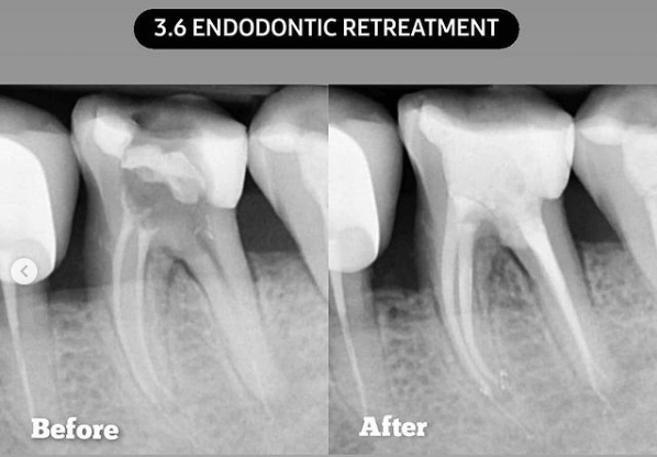 refacerea dintelui tratament endodontic